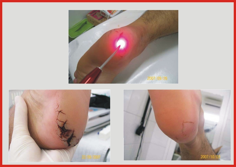 tratamento com laser,laser,tratamento para rachaduras